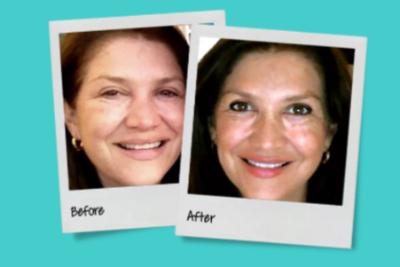 Collagen Before & Afters